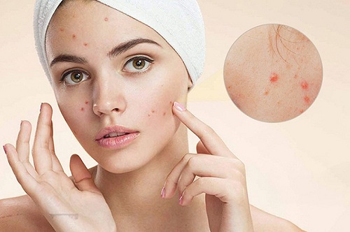  Chăm sóc da sau nặn mụn để không bị thâm? 